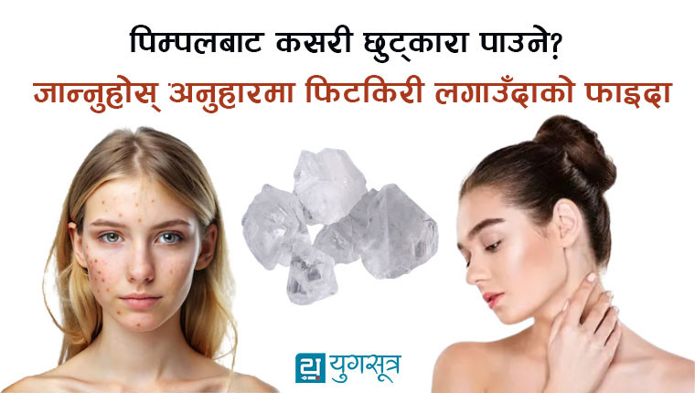 पिम्पलबाट कसरी छुट्कारा पाउने? जान्नुहोस् अनुहारमा फिटकिरी लगाउँदाको फाइदा