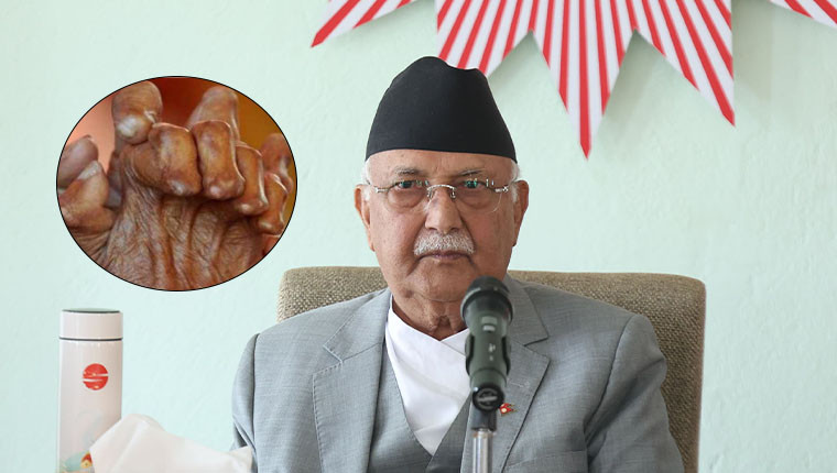 कुष्ठरोग निवारण अभियानलाई अझ गतिशील बनाउनुपर्छ : प्रधानमन्त्री केपी शर्मा ओली